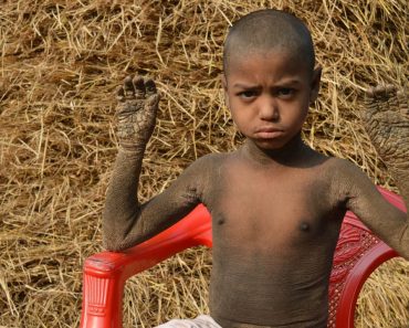 Menino De 8 anos Com Doença Rara Tem a Pele a Transformar-se Em Pedra