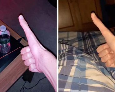 Jovem Torna-se Famoso Na Internet Ao Mostrar o Seu Polegar Gigante
