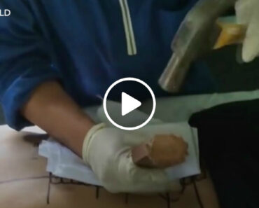 Quiroprático Da Malásia “Repara” Hérnia De Disco Com Um Martelo Quiroprático Da Malásia “Repara” Hérnia De Disco Com Um Martelo