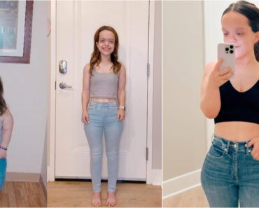 Mulher Com Nanismo Surpreende Fãs Após Cirurgia De Aumento De Altura Mulher Com Nanismo Surpreende Fãs Após Cirurgia De Aumento De Altura